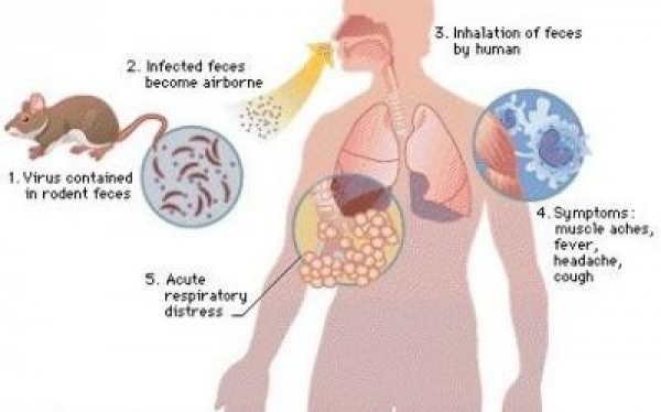 Hantavirus : les symptômes après exposition